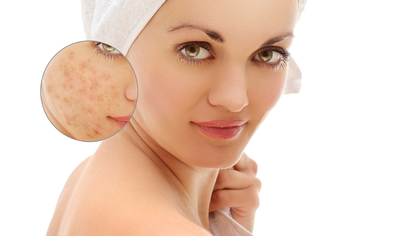 How-To-Get-Rid-Of-Eczema Scars