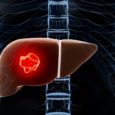 Why India is the Most Preferred Destination for Liver Transplants?