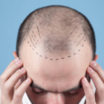 what all you need to know about Hair Transplantation