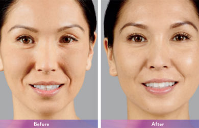 How Can Juvederm Voluma Help Delay Your Desire For Facial Surgery?